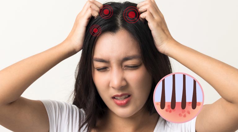 成日頭痕痕係咪頭皮敏感？